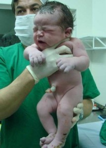 Parto de bebé com 5,2 kg surpreende médicos